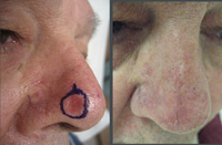 This is a biopsy proven basal cell cancer, which was excised using the Mohs micrographic surgical technique.<br />
            It was then closed with a bilobed flap, and the scar was revised.<br />
            The second photo was taken 3 month post-operative.