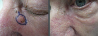 Las Vegas Dermatology patient with Basal cell cancer marked prior to Mohs micrographic surgery. <br />
            The second photo shows the same patient 6 weeks after surgery.